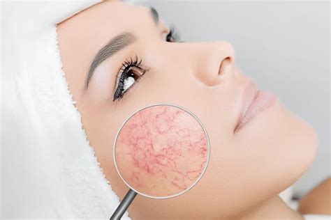 Best Effective Way To Treat Skin Discoloration Laser Treatment