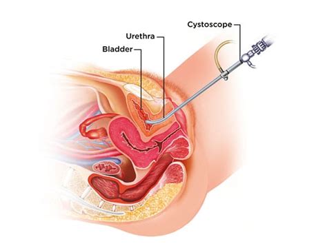 There may be enough blood to change the color of the urine orange, pink or (less often) red. Bladder Cancer Detection & Diagnosis | Cxbladder