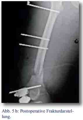 We did not find results for: BEHANDLUNGSVERLAUF EINER SUBTOTALEN OBERSCHENKELAMPUTATION ...