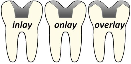 Inlays and Onlays treatment in Delhi NCR, teeth capping treatment cost Delhi