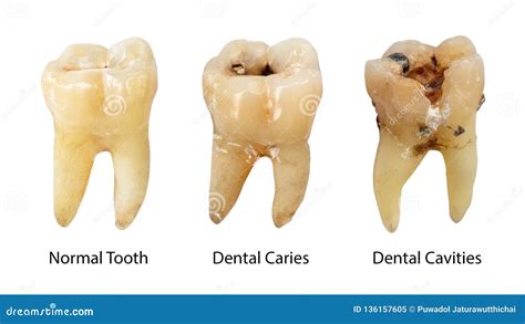 Different Stages Of Tooth Cavity