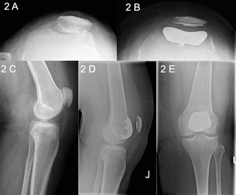 Patellofemoral Joint Pfj Arthritis A Skyline X Ray Showing Pfj