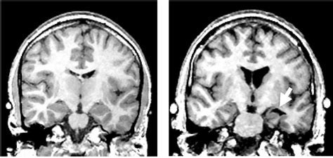 Figure 1 From A Review Of Mri Findings In Schizophrenia Semantic Scholar