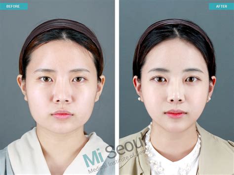 Korea Plastic Surgery Before And After Photos
