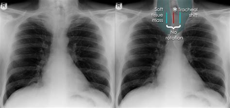 Chest X Ray Abnormalities Tracheal Displacement