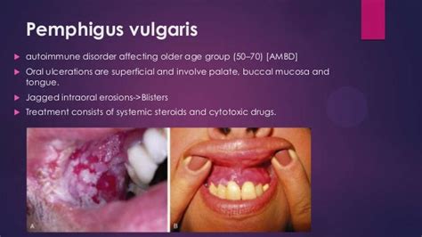 Lesions Of Oral Cavity