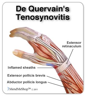 De Quervain S Tenosynovitis Hand Therapy De Quervain S Tenosynovitis Thumb Tendonitis Kulturaupice