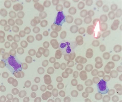 Are These Reactive Lymphocytes Im A Student And Still Have Trouble