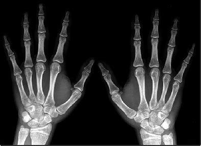 I jammed my hand into my wrist pushing a large parcel cart into a curb after getting a running start. Hand X-ray showed soft tissue swelling around the proximal ...