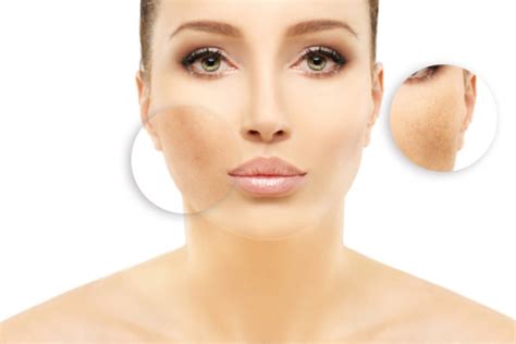 The Causes Of Hyperpigmentation And Treatment Options Vargas Face And