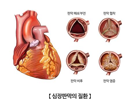 삼첨판 인체정보 의료정보 건강정보 서울아산병원
