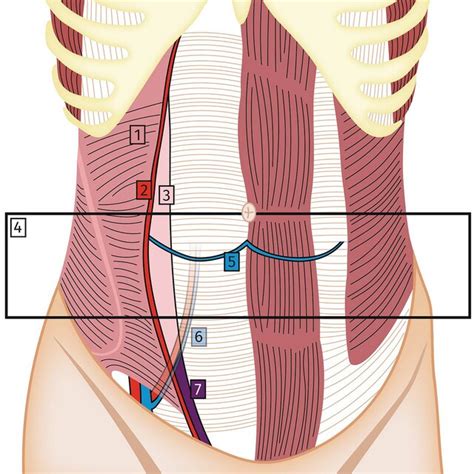 Spigelian Hernia Surgical Anatomy Drawing Depicting A Left Sided