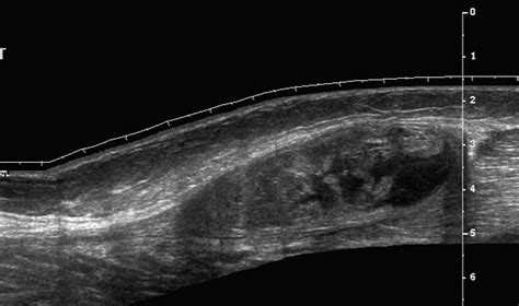 Isolated Tear Of The Tendon To The Medial Head Of Gastrocnemius