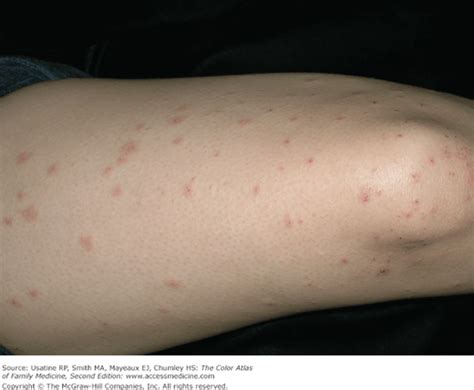 Pruritic Urticarial Papules And Plaques Of Pregnancy Basicmedical Key