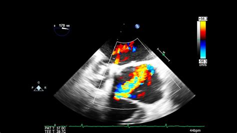 Use Of Ultrasound In Cardiac Arrest Em Ultrasound Section