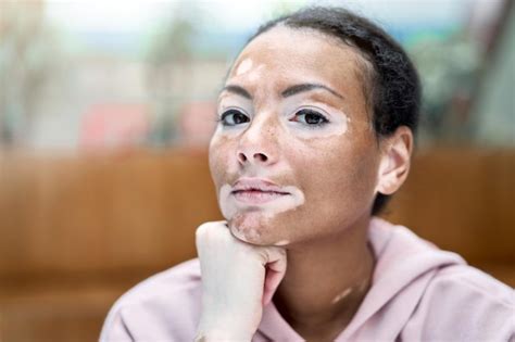 Premium Photo Black African American Woman With Vitiligo Pigmentation