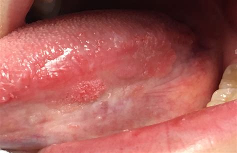 Oral Cancer On Tongue Look Like