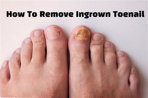 How To Remove Ingrown Toenail Step By Step Beautys Guide