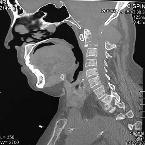 Midsagittal Plain Computerized Tomography Scan Of The Cervical Spine