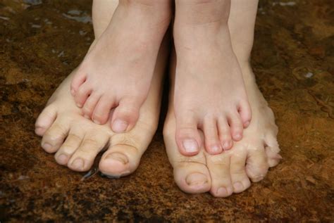 Common Foot Disorders In Children Dallas Podiatry Works