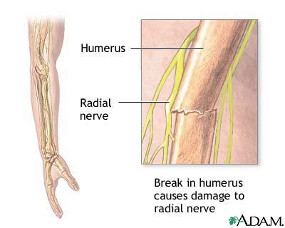 Radial Nerve Dysfunction MedlinePlus Medical Encyclopedia Image