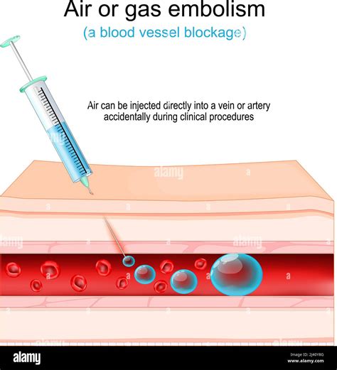 Air Or Gas Embolism Blood Vessel Blockage Air That Injected Directly