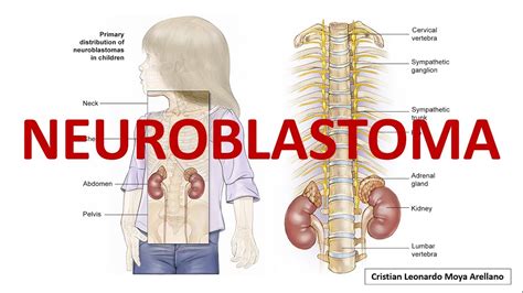 🔴 Neuroblastoma Youtube
