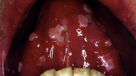 Pemphigus Vulgaris On Lips