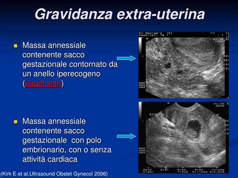 Ppt Gravidanza Extra Uterina Caso Clinico E Review Della Letteratura