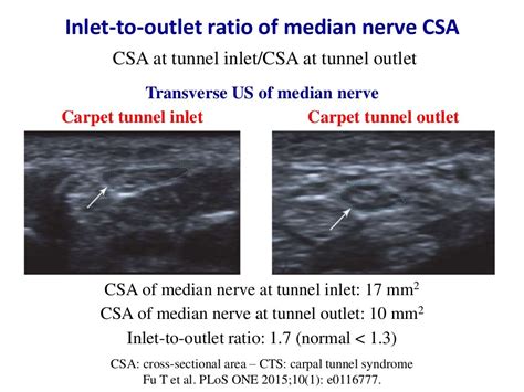 Ultrasound Of Carpal Tunnel Syndrome