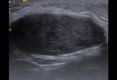 Breast Lumps In Young Women Diagnostic Approaches