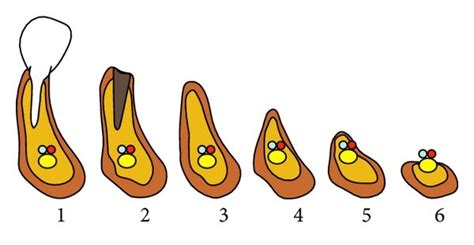 Classification System Of Six Atrophy Stages In The Mandible According