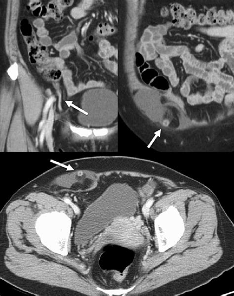 Enhanced Abdominal Computed Tomography Shows A Right Direct Inguinal