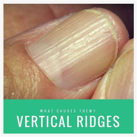 Vertical lines on nails can indicate your nails are aging or metabolic dysfunction (including autoimmune disorders). Onychorrhexis are vertical ridges on the nails. They ...