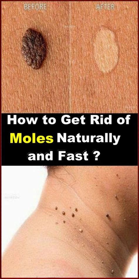 How To Get Rid Of Moles Fast And Naturally Skin Name Skin Moles