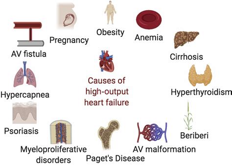 High Output Heart Failure Associated With Arteriovenous Fistula In The