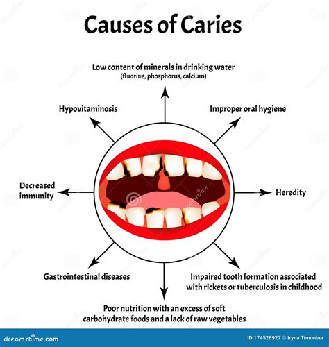 Causes Of Caries Poster Cartoon Vector 114024435