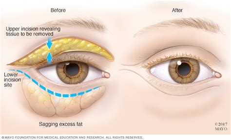 If you wear prescription glasses or contact lenses, you may have wondered what. Bags under eyes - Diagnosis and treatment - Mayo Clinic