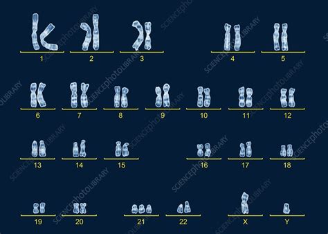 Male Karyotype With Down S Syndrome Stock Image C016 6749 Science