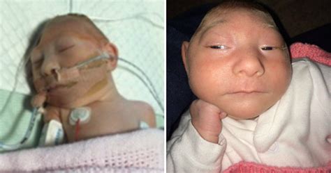 An Identical Twin Born Without 90 Of Her Brain Defies Doctors Metro News