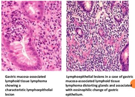 Pdf Cystic Changes In Mucosa Associated Lymphoid Tissue Lymphoma Of