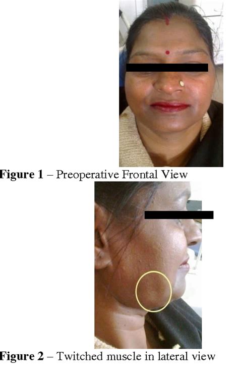 Figure 1 From Unilateral Masseter Hypertrophy With Unusual Twitching