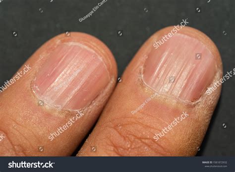 Vertical Ridges On Fingernails Symptoms Deficiency Stock Photo