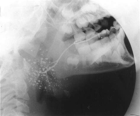 Bilateral Parotid Swelling A Review Oral Surgery Oral Medicine