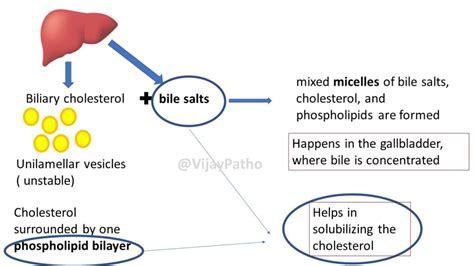 Gall Stonescholelithiasis Pathogenesis Pathology Made Simple