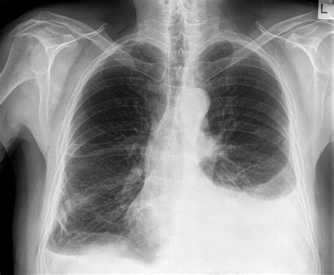 Atelectasis Chest X Ray Medschool