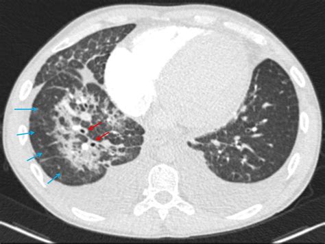 Cardiogenic Pulmonary Edema Unilateral Image