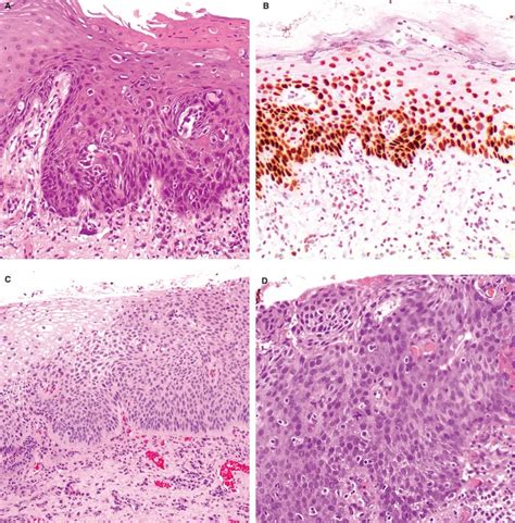 Vulvar Intraepithelial Neoplasia Of The Differentiated Simplex Type