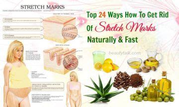 Top 24 Ways How To Get Rid Of Stretch Marks Naturally Fast