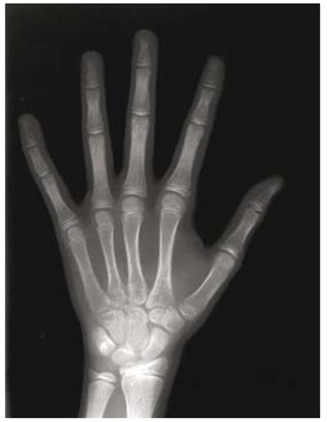 A Posteroanterior Hand Wrist Radiograph From A 10 Year Old